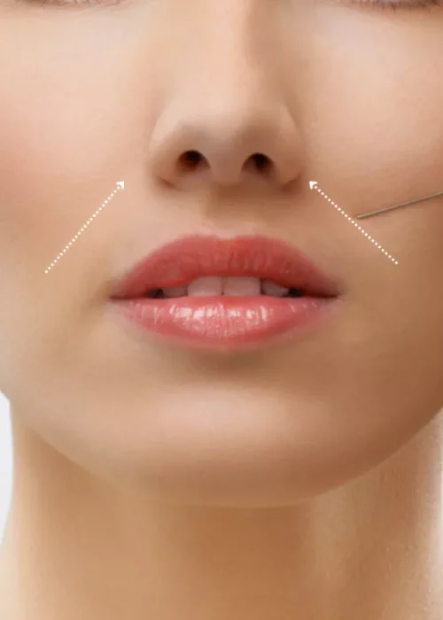 Modelo para surco nasogeniano