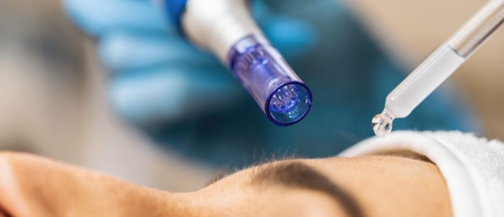 dermapen tratamientos