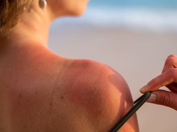 que es una insolacion