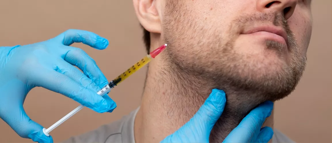 Ácido hialurónico en mentón - Nurson Formación Ácido hialurónico en mentón - Nurson Formación